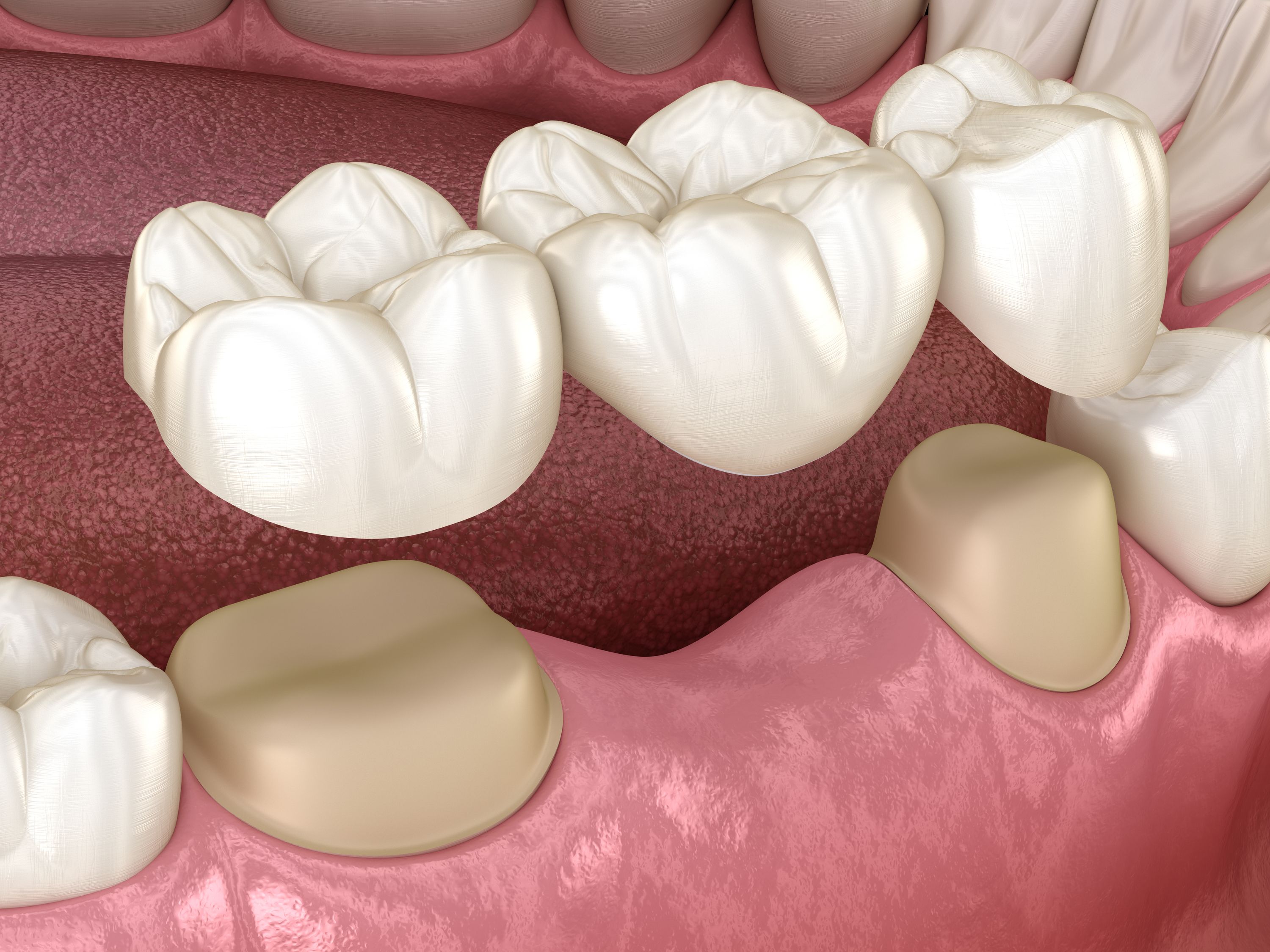 Gluing A Dental Bridge at Taylor Carman blog